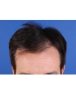 Before Hair Transplant&nbsp;Hairlines